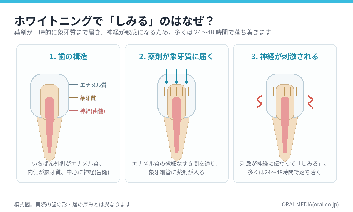 ホワイトニングでしみる仕組みを歯の断面で示した図